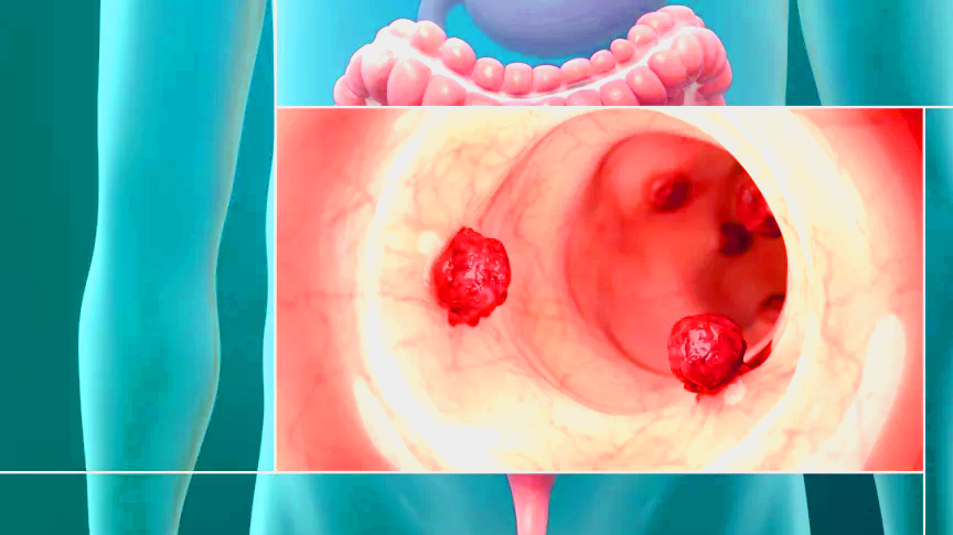 the best treatment for colon cancer