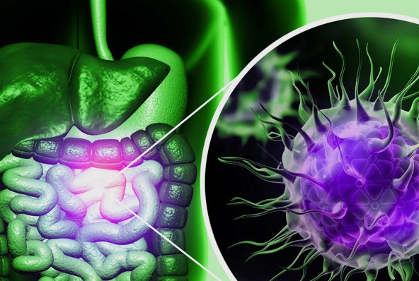 The early signs of colon cancer