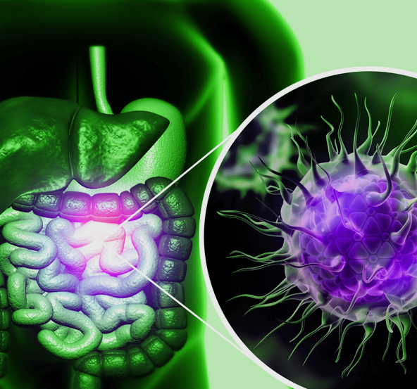 The early signs of colon cancer