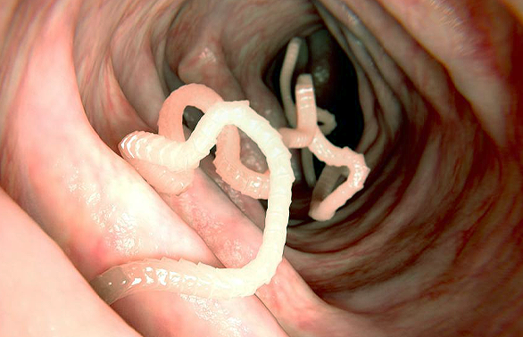 Some common medications used to treat intestinal worms stomach in humans