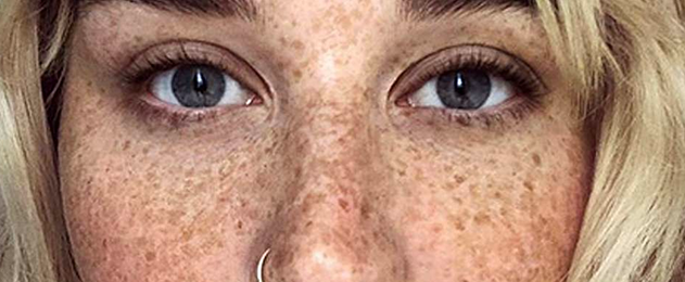 Preventing and Treating Freckles