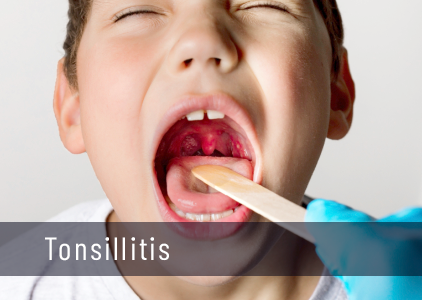 Tonsillitis: Symptoms, Causes, Treatments, Surgery (Tonsillectomy)