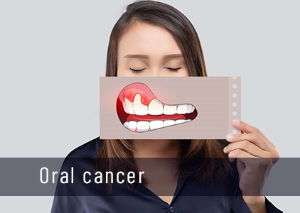 Oral cancer: Symptoms & Medicine Treatment