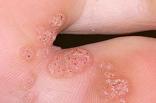 symptoms of HPV, Warts 