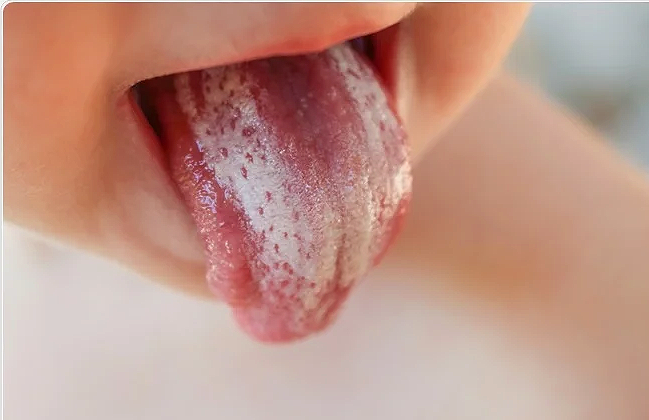 What are some causes of oral thrush?